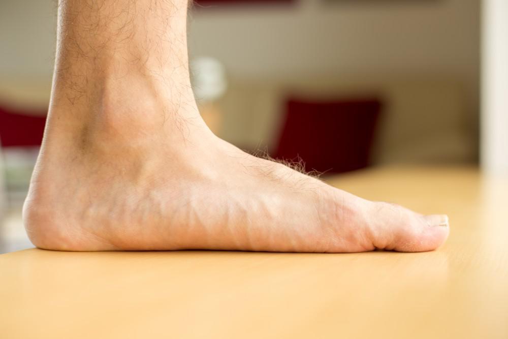 Don’t Ignore Flat Feet